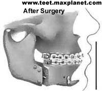 After Surgery/orthognathic surgery