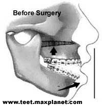 Before Surgery/orthognathic surgery