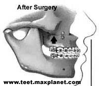 After Surgery/orthognathic surgery