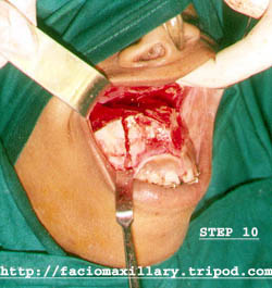 Anterior maxillary osteotomy (fig:10)