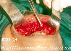 Cinch suture (fig:14)