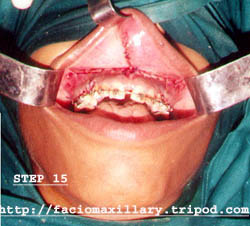 Mucosal suture (fig:15)