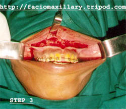 Mucoperiosteal incision (Fig:3)