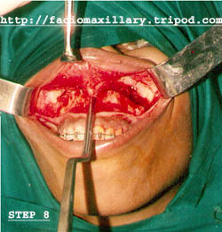Nasal septum and vomer osteotomy (fig:8)